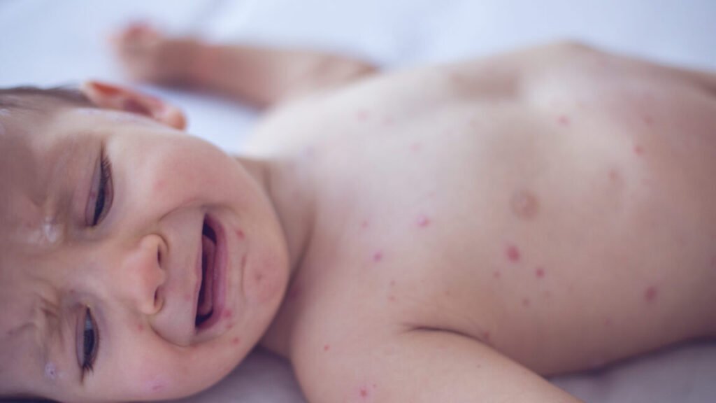 Crying baby girl with measles
